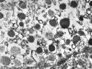 F,68y. | APUD carcinoma